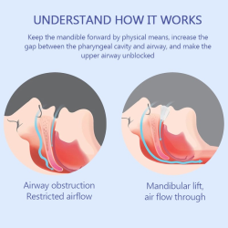 Beißen und Geräte No-Snore Anti-Schnarch-Gerät